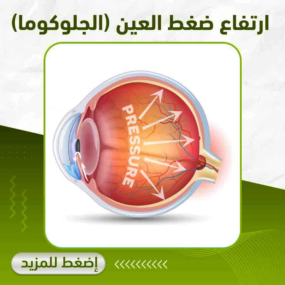 ارتفاع ضغط العين - صيدلية أبوتيك بلس