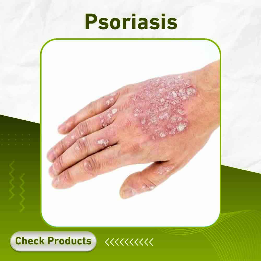 psoriasis - Apotek Plus Pharmacy