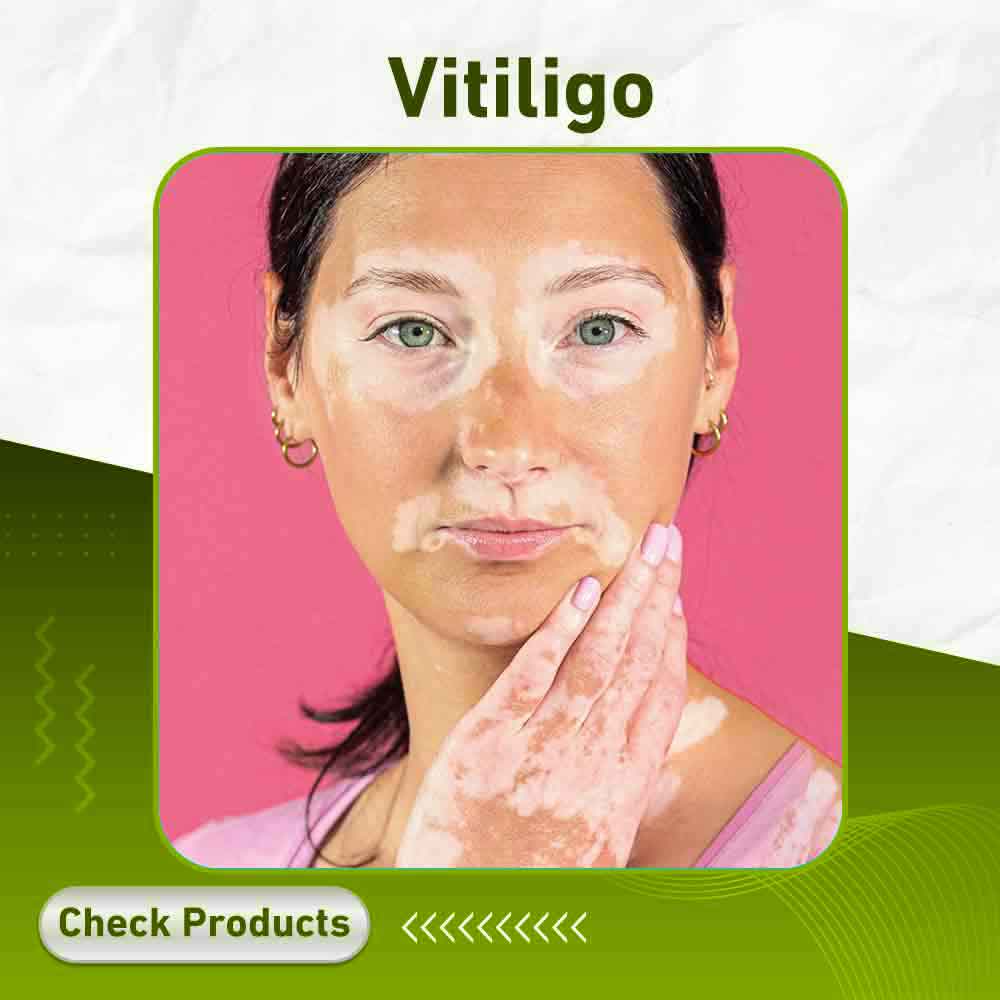 vitiligo - Apotek Plus Pharmacy