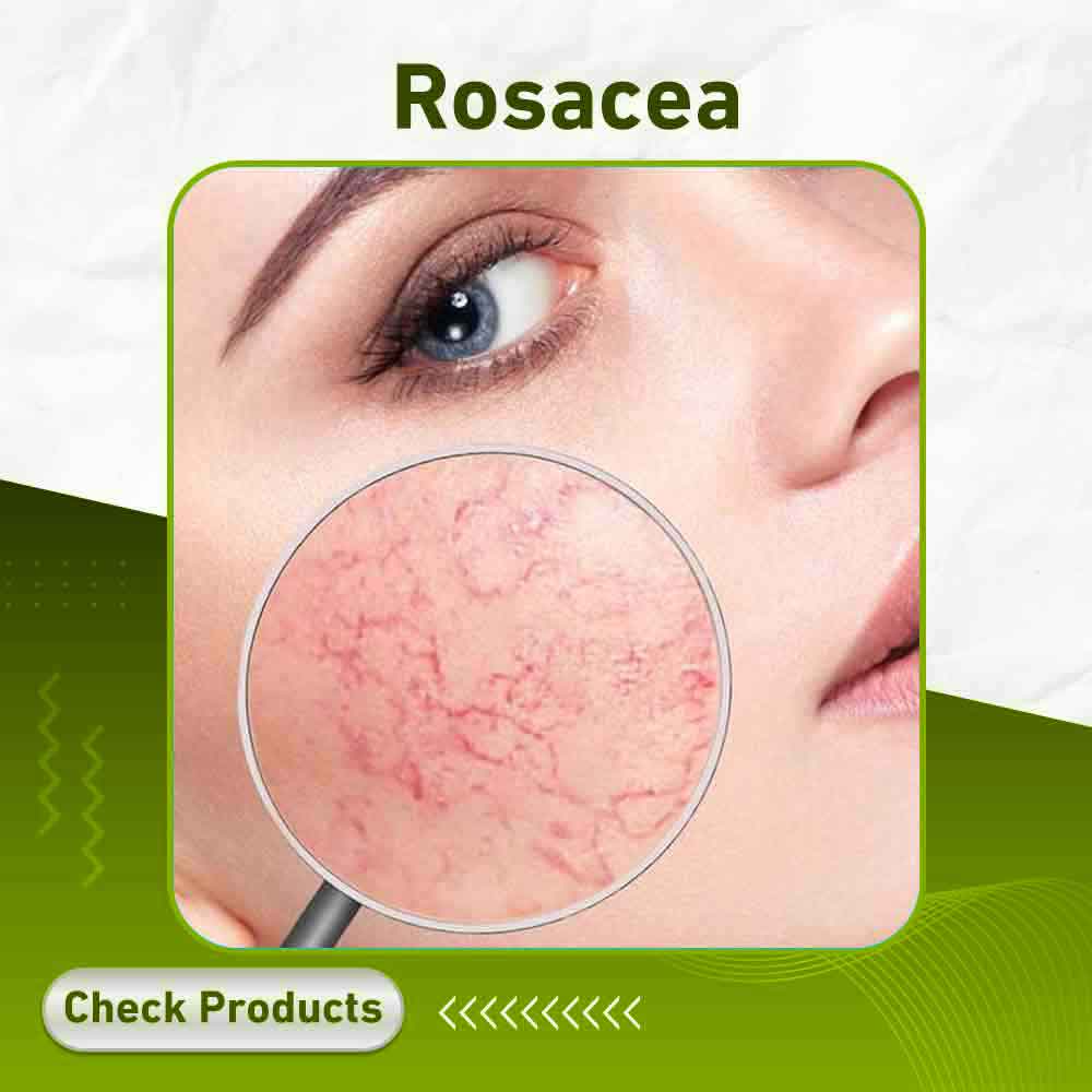 rosacea - Apotek Plus Pharmacy