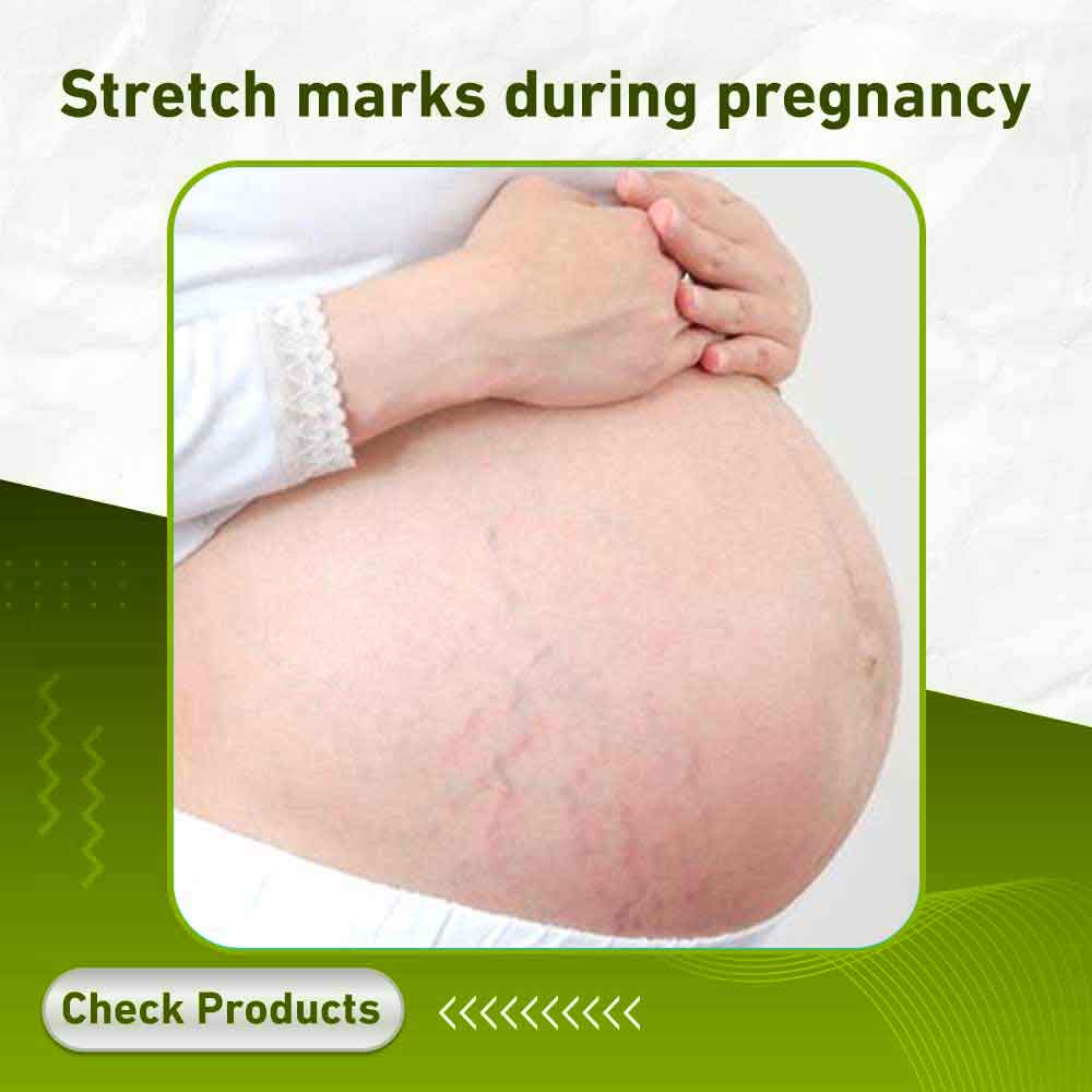 Stretch marks during pregnancy - Apotek Plus Pharmacy