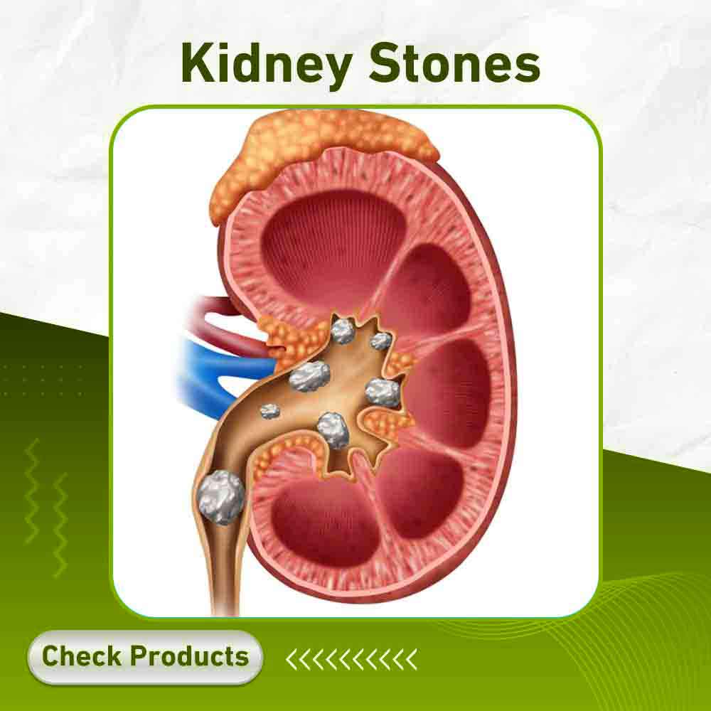 Kidney Stones - Apotek Plus Pharmacy